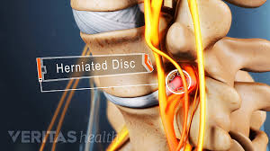 This pain is caused by the muscles, skin, and blood vessels in your buttocks pressing on nerves. Exercise For Sciatica From A Herniated Disc