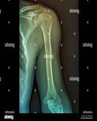 Image result for Shoulder XRay