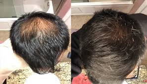 Nearly 83% of men who continued treatment for 2 years either saw a complete stop of hair loss, an increase in hair growth, or both. Finasteride For Hair Loss Dose Results Side Effects
