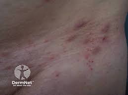Image result for scabies in the groin area