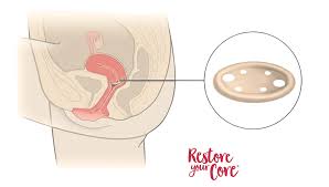 Image result for Pessary