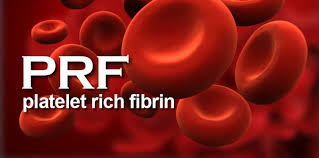 An indispensible adjunct in implantology. Prf Platelet Rich Fibrin Hamilton Dental Surgery Dentistry On 7th