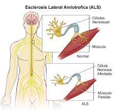 Española ela, asociación de esclerosis lateral amiotrófica de ca и esclerosis lateral amiotrófica. Amyotrophic Lateral Sclerosis Als