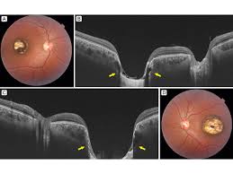Image result for Coloboma