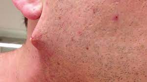 When you wax, will pull the hair right out of the follicle and will totally eliminate any chances of having. Is This The Longest Ingrown Hair In History Man Films Himself Removing Pus Covered Black Strand Mirror Online