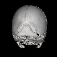 We did not find results for: Mercedes Benz Craniosynostosis Syndrome Radiology Reference Article Radiopaedia Org