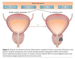 A biopsy is when a small piece of tissue is removed from the prostate and looked at under a microscope. The Link Between Benign Prostatic Hyperplasia And Prostate Cancer Document Gale Academic Onefile