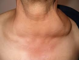 Her lenfoma kendine özgü olup bazıları diğerlerinden daha saldırgandır. Prof Dr H Ismail Sari On Twitter Lenfoma Nedir Akillimolekuller Hedeftedavi Hematolojiistanbul Hodgkindisilenfoma Hodgkinlenfoma Kemikiligibiyopsi Kemoreterapi Kokhucrenakli Lenfbezikanseri Lenfadenopati Lenfoma