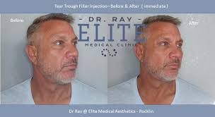 Very informative staff and explained everything so well that i could understand the process of the laser hair removal. Best Botox Liposuction Dr Ray Medical Aesthetics Rocklin