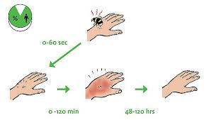 Bumblebee venom, similar to wasp venom or honeybee venom, affects the blood vessels of. Treatment Of Bumblebee Stings And Allergies Koppert