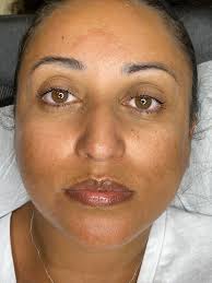 Dark Lips Treatment Package. Lighten your dark lips. For appointments  please call: Tariq Road Karachi: 0303-2227427, 0306-2227427,  021-34304442-3. DHA Karachi: 0321-1225719 021-38883275. North Nazimabad:  0300-1482200, 0300-1482201, 021-36648547 ...