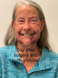 Bionic Smile Team Patient Experience with Surgery and Permanent Installation