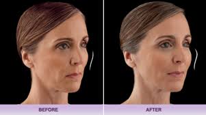 Juvederm is injected into the skin to create volume, resulting in a healthy and vital appearance. Dermal Fillers