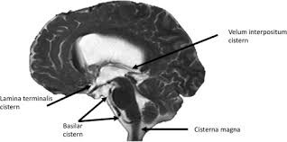 The Basal Subarachnoid Cisterns Surgical And Anatomical Considerations Sciencedirect