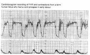 Image result for Late Deceleration