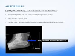 In the control group, the mean haglund's deformity height was 9.0 (range, 5.2 to 12.1) mm and the peak angle was 105 (range, 91 to 124) degrees. Epos Trade