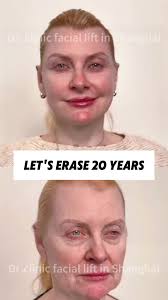 🌟 หน้าโทรม? ไม่มีอีกต่อไป! เทคนิคยกกระชับหน้าแผลเล็กของหมอ ช่วยให้หน้าเด้ง  สวยธรรมชาติ ไม่ต้องกลัวหน้าแข็ง! 💕 สาวๆ  คนไหนอยากหน้าเด็กแบบไม่ต้องแต่งหน้าก็ปัง? ทักมาถามเลย ...