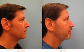 Nose Surgery Before And After Men Http Www Drwolfrhinoplasty Com Rhinoplasty Nose Surgery Male Rhinoplasty Miam Rhinoplasty Plastic Surgery Cosmetic Surgery