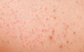 Triebe, die von innen kratzen! Hilfe Bei Rasurbrand Eingewachsenen Haaren Follikulitis Laseraesthetik Berlin Mitte