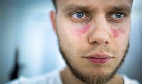 Your Ultimate Guide to Lupus: Symptoms, Management, and Skincare