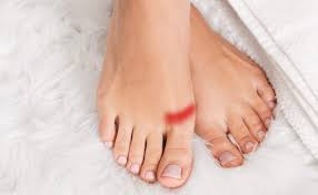 Image result for Hallux Varus