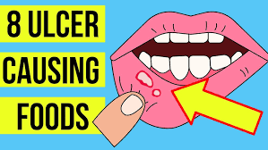 Image result for Mouth ulcers roof of mouth