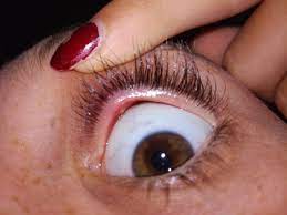 Gemeint sind pickel am augenwinkel oder an den lidrändern. Was Ist Das An Meinem Auge Hiilfe Lied Augen Pickel
