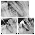 Root canal treatment product image