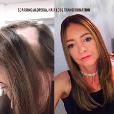 Scarring Alopecia In 2020 Scarring Alopecia Hair Loss Women Hairstyles For Thin Hair