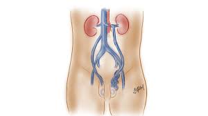 Image result for Varicocele