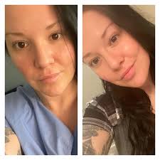 Has anyone here had an explant with enbloc where they didn't need drains?