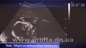Abort Po Medicinskim Pokazaniyam Prigovor Ili Neobhodimost Youtube