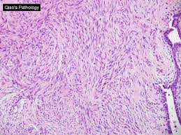 Malignant phyllodes tumors (mpt) have a poor prognosis, with most patients dying within 3 years after starting treatments 1. Qiao S Pathology Malignant Phyllodes Tumor A Photo On Flickriver