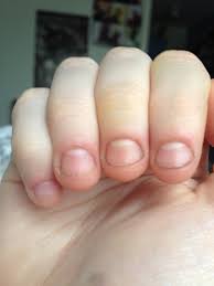 See full list on wikihow.com How To Fix And Grow Out Bitten Nails B C Guides