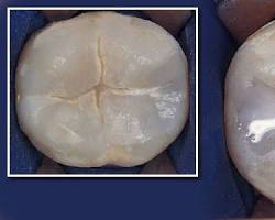 What are the types of Dental Treatment?