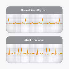 Image result for Atrial Fibrillation