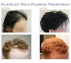 For example, dermatologists and hair replacement experts use prp injections to treat a type of hair loss called androgenic alopecia, also known as male or female pattern baldness, which affects men. Prp Treatments For Hair Loss And Skin Rejuvenation Dr Shapiro Aesthetic Plastic Surgery Skin Klinic