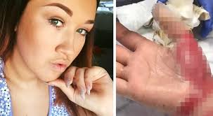 ✓ Manikura se je končala z opeklinami