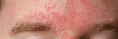 Image result for Seborrheic Dermatitis