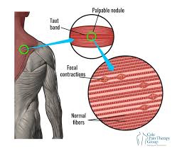 Image result for Pain Disorder