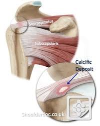 Image result for Rotator Cuff Calcification