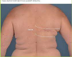 Image result for zoster under breasts