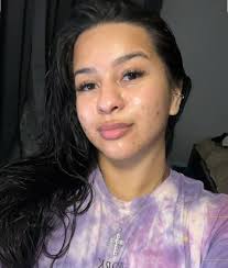 What helps get rid of tiny bumps and texturized skin?