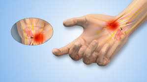 Hand Numbness & Tingling – DENNIS O. SAGINI, MD
