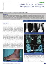 People who have had surgery for fibula fractures may develop chronic swelling around their ankle. Pdf Isolated Tuberculous Peroneal Tenosynovitis A Case Report Isolated Tuberculous Peroneal Tenosynovitis A Case Report