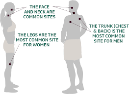 But you may be surprised by other things that can lead to cancer. Understanding Melanoma