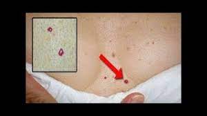 dikkat sizin de derinizde bu kirmizi noktalardan var mi iste nedeni youtube