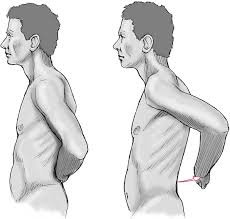 Image result for Lift-Off Subscapularis Test