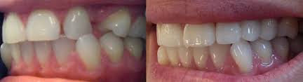 Here are some ways to close the teeth gaps without braces treatment: Fix Gaps In Teeth Without Braces Lingual Braces Dental Food