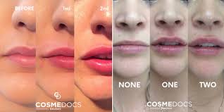 Our lip injection aftercare arnica balms serve as natural healing and soothing solution with branded options for an added touch of vegan filler and lip injection aftercare. Lip Fillers Before And After A Transformation For The Better